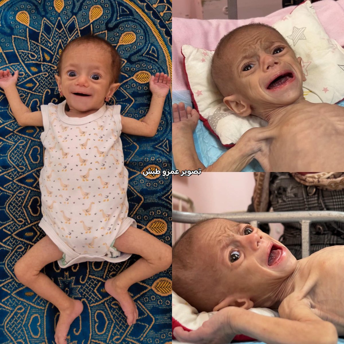 Suwar Ashour left Gaza weighing only 3 kg due to severe hunger. After six weeks of treatment abroad, she now weighs 3.9 kg with slight improvement but still needs long-term care. Thousands of children in Gaza face the same deadly hunger, many dying before aid arrives.