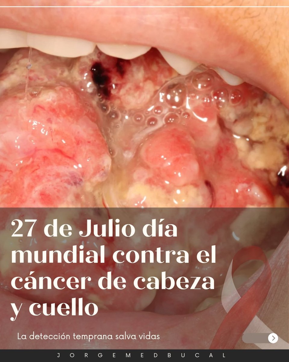 Hoy 27 de Julio se conmemora el día contra el cáncer de cabeza y cuello. 🗣️🦀

Abro hilo. 🔎