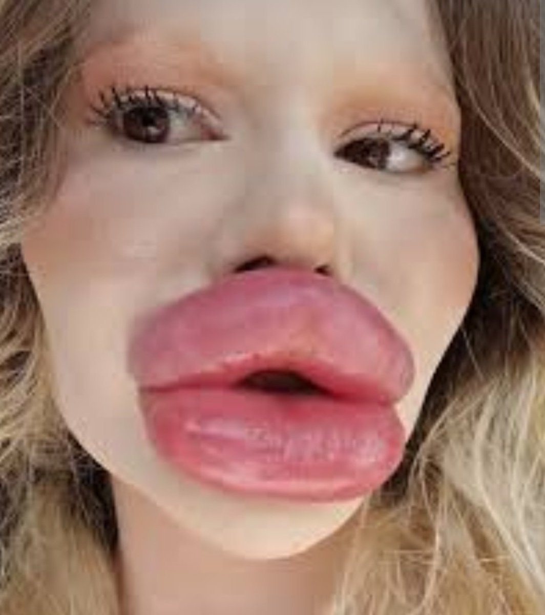 Woman with the world's largest lips! Before &amp; after pictures of Andrea Ivanova