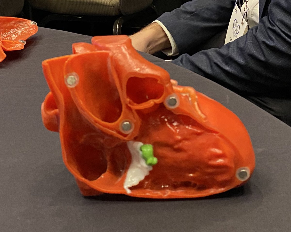 Another fantastic presentation by <a href="/aelsab/">Abdallah El Sabbagh</a> at <a href="/cvinnovations/">CV Innovations</a>  2025, complete with 3D printed model. Transcatheter Removal of Intracardiac Masses (TRIM) techniques. 
<a href="/NahyrLugo/">Nahyr Sofía Lugo-Fagundo, MD</a> <a href="/RashidAlhusain/">Rashid Alhusain</a> 
<a href="/PaulSorajj74157/">Paul Sorajja</a> <a href="/HamidNadira/">Nadira Hamid</a> <a href="/rooshaparikh/">Roosha Parikh</a> <a href="/GAilawadiMD/">Gorav Ailawadi</a> <a href="/mj_ricciardi/">Mark J Ricciardi MD</a>
