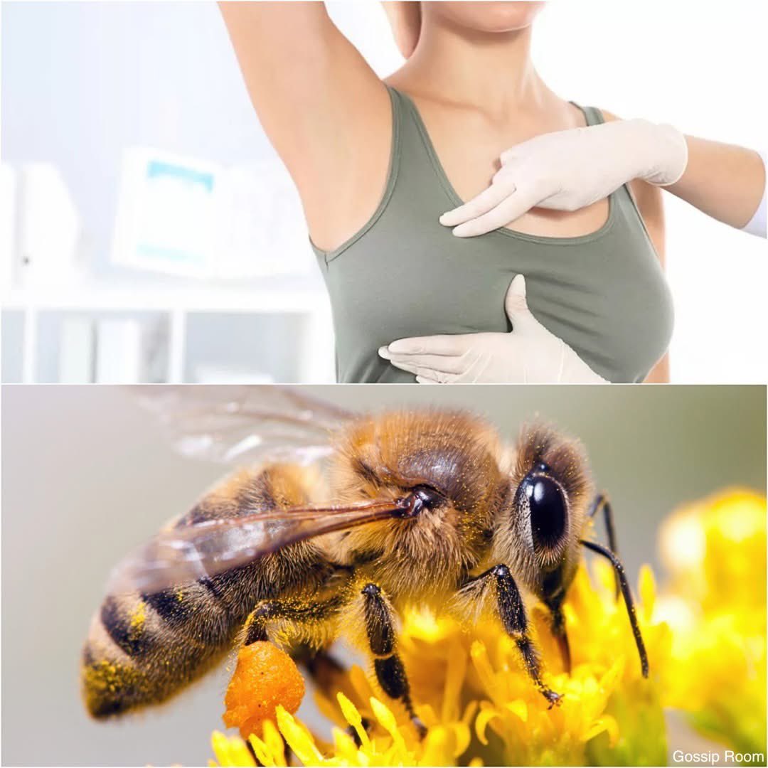GossipRoomOff's tweet image. 🚨 Et si une piqûre d’abeille devenait une arme contre le cancer ? Une étude australienne révèle que le venin d’abeille, et plus précisément la mélittine qu’il contient, peut détruire jusqu’à 100 % des cellules du cancer du sein les plus agressives, tout en épargnant les cellules…