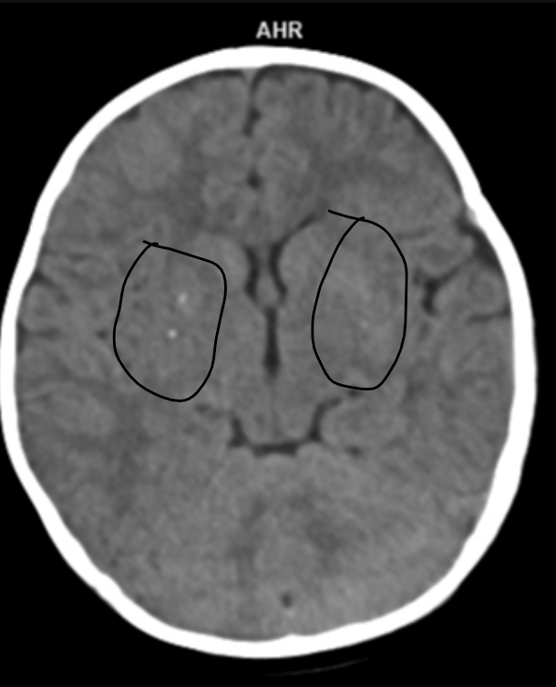 Ganymade__'s tweet photo. ⛳️Mineralizing angiopathy
-When you see bilateral punctate basal ganglia calsifications at the child scan, please consider this entity 
-It is a risk factor for pediatric stroke especialley at minor and mild trauma
#usmle #residency #Neurology  #radiology

https://t.co/rQ2bhn8gFn https://t.co/6uNk6f6NR4