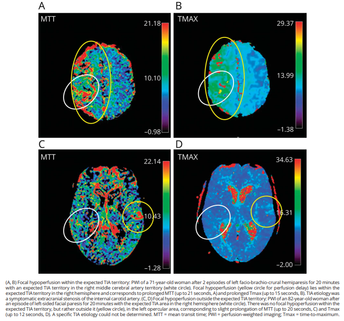 ❓Should Perfusion-weighted Imaging (PWI) be part of the acute TIA workup❓

💡Our new study demonstrates a higher stroke rate in TIA patients with focal hypoperfusion on PWI MRI, particularly when in the expected TIA territory💡 
<a href="/GreenJournal/">Neurology Journal</a> <a href="/StrokeBern/">Stroke Research Center Bern</a> doi.org/10.1212/WNL.00…
