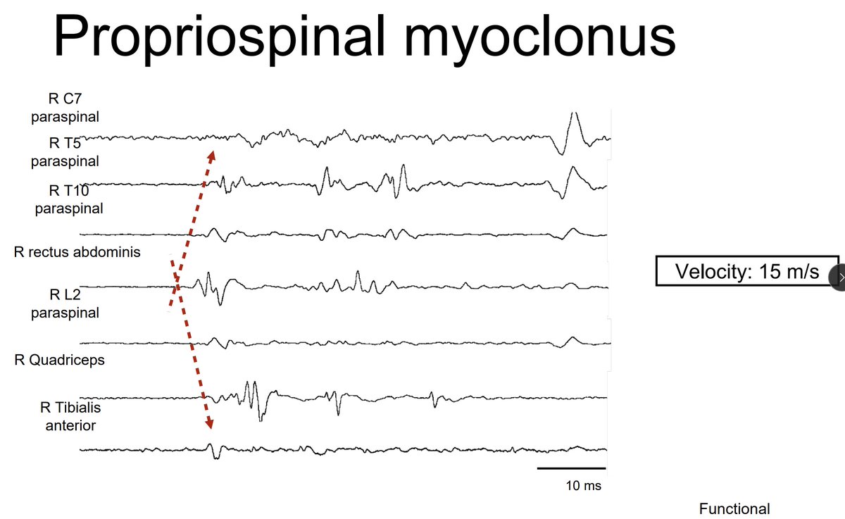 Michael Okun (@michaelokun) on Twitter photo What David Marsden originally described as propriospinal myoclonus is now known today to be predominantly a functional movement disorder. Tony Lang brings us up to speed in Aspen Day 1 on a comprehensive review of myoclonus. <a href="/FixelInstitute/">Norman Fixel Institute for Neurological Diseases</a> <a href="/movedisorder/">MDS</a> #myoclonus What David Marsden originally described as propriospinal myoclonus is now known today to be predominantly a functional movement disorder. Tony Lang brings us up to speed in Aspen Day 1 on a comprehensive review of myoclonus. <a href="/FixelInstitute/">Norman Fixel Institute for Neurological Diseases</a> <a href="/movedisorder/">MDS</a> #myoclonus