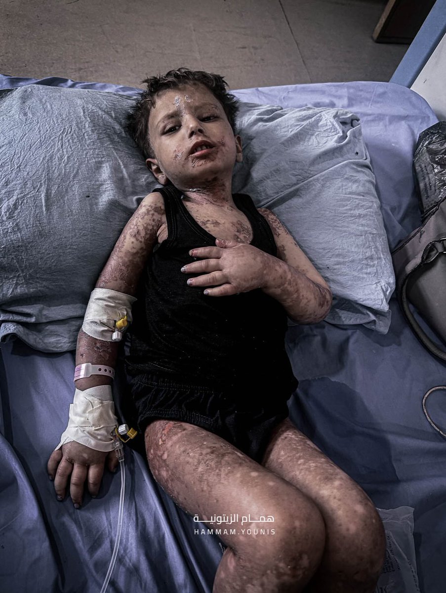 The child Amir Al-Mughanni, 3 years old, is one of the many children who have suffered from famine and malnutrition, which has severely affected his health and put his life at risk.