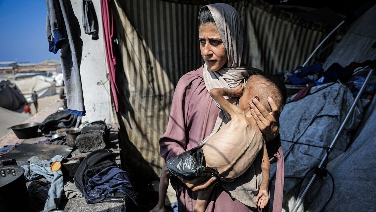 Muhammad Zakariya Ayyoub al-Matouq, a 1.5-year-old child, faces life-threatening malnutrition as the humanitarian situation worsens due to ongoing Israeli attacks and blockade in Gaza City on Monday.

<a href="/CNN/">CNN</a> | Ahmed Jihad Ibrahim