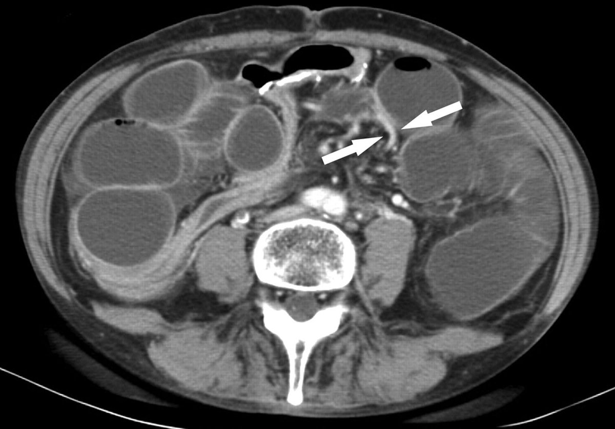 radRounds's tweet image. Ileus or SBO?  Diagnosis?  Source: AJR
