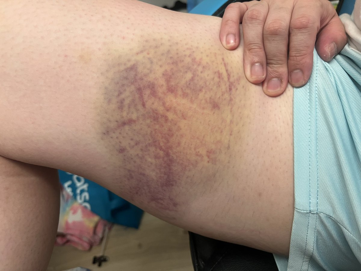 以外と青タンでかくなってた🐻