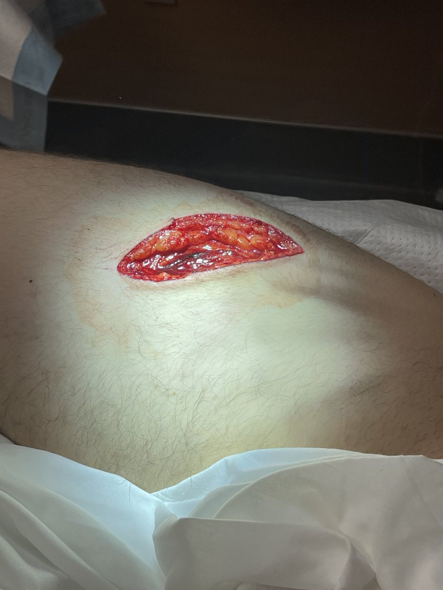 TrevorBello's tweet image. Had a run in with the skillsaw today... the skillsaw won.
Counting my blessings over here.