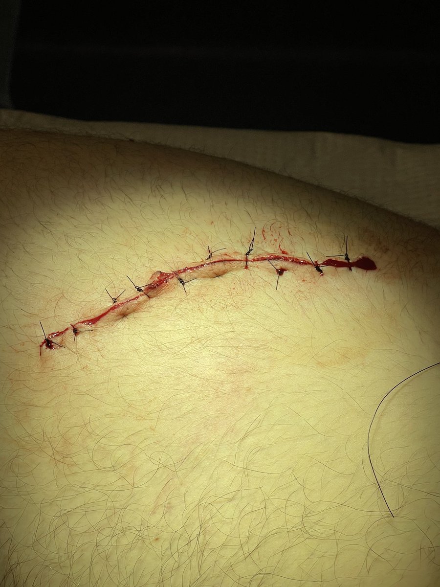 TrevorBello's tweet image. Had a run in with the skillsaw today... the skillsaw won.
Counting my blessings over here.