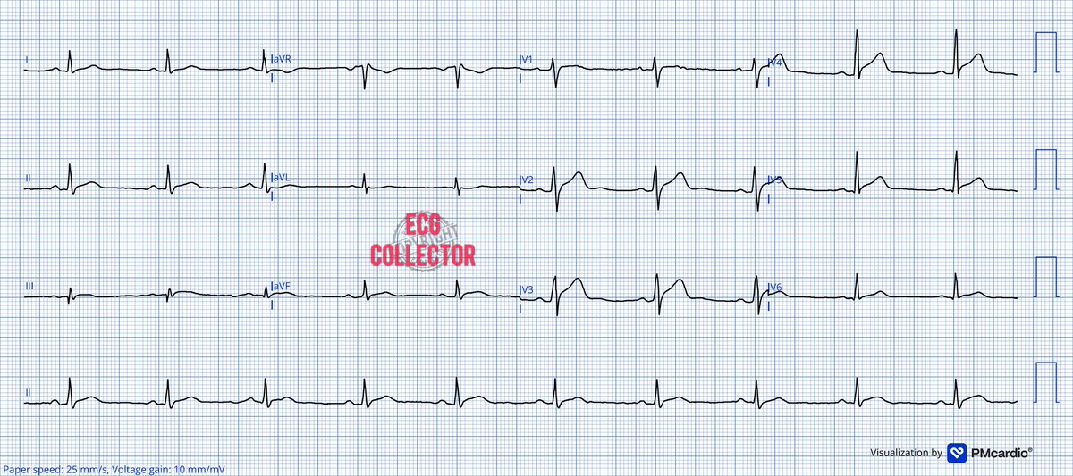 Dr Razi (@drrazi4) on Twitter photo 32 year old male; active smoker; active chest pain for few hours; PS 5/10; VS stable; History fever 2 weeks ago;
What do you thinkāš¤
<a href="/PMcardioApp/">PMcardioāAI that reads ECGs</a>
#ECG
#EKG
#CardioTwitter
#Cardiology
#medicalstudent
#MedTwitter 32 year old male; active smoker; active chest pain for few hours; PS 5/10; VS stable; History fever 2 weeks ago;
What do you thinkāš¤
<a href="/PMcardioApp/">PMcardioāAI that reads ECGs</a>
#ECG
#EKG
#CardioTwitter
#Cardiology
#medicalstudent
#MedTwitter