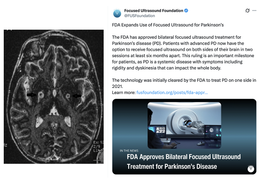 MichaelOkun's tweet photo. Today in Aspen we talked about the importance of staging bilateral focused ultrasound lesions in the GPi for treatment of Parkinson's. It just received FDA approval and the data published in @NEJM. Remember to use multidisciplinary screening, discuss risks and benefits, and be careful with the second lesion. Neurosurgeons are leading the way in teaching us where and how (smaller) to make the second lesion to avoid the historical bilateral pallidotomy side effects we all fear. Nice discussion in Aspen today. @ParkinsonDotOrg @movedisorder #Parkinsons