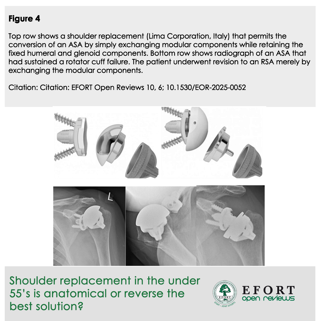 Under 55  &amp; #shoulder replacement?
#EOR article tackles #ASA vs. #RSA
ASA for intact cuff 💪, RSA for complex cases 
🔄Both have good short-term outcomes in young, longevity &amp; revision challenges persist
🔗 bit.ly/EOR250609
#EFORT #EORJournal #ShoulderArthroplasty