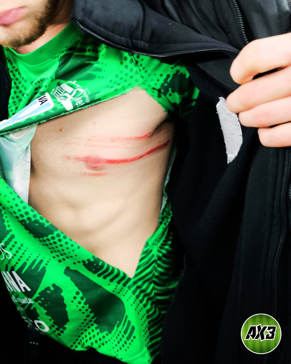 ElAscensox3's tweet image. 📸Imagenes de alguno de los jugadores de VICTORIANO ARENAS agredidos en cancha de Central Ballester.

Fede Ulayar, quien había sido hospitalizado, recibió suero y antibioticos y ya se encuentra con el plantel.

Luis Ventura, está en el Sanatorio Trinidad haciendose una…