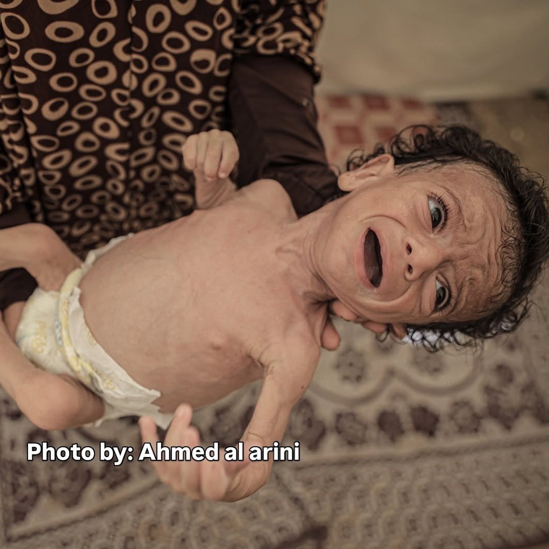 El bebé palestino Salim Mahmoud Awad de 7 meses, sufre de desnutrición severa debido al bloqueo y la hambruna impuesta por Israel en Gaza.
