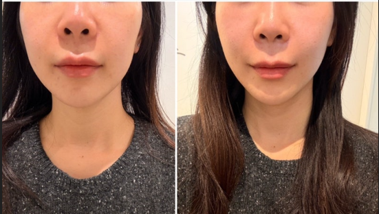 YOURCLINICJP's tweet photo. 若見えの秘密は⁉#ベンスクリニック の #リフティングレーザー で切らない #輪郭整形✨
#たるみ #脂肪 撃退で美しいVライン🤍#ホンデ店 #明洞 #江南 #ソンス #COEX

#オンダリフト 20kj 6.9万₩
#シュリンク 6.9万₩
#ボルニューマ 29万₩

RT&amp;フォローで7月以降も適用可能✨

#小顔 #弾力 #韓国美容 https://t.co/a303awmFjd