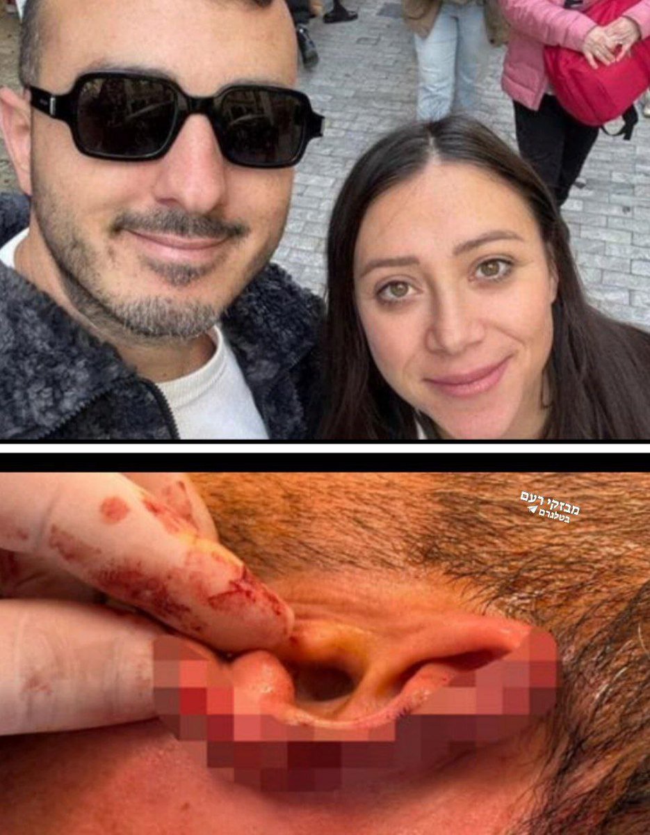 🔴🔴🔴
المواطن الإسرائيلي الذي تعرض لهجوم في 
اليونان من قبل مواطن سوري وقطع اذنه .