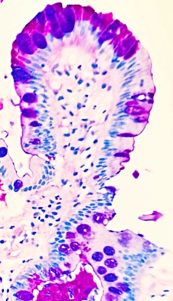 Sara Amin (@saraaminmd) on Twitter photo AB/PAS; a pretty colorful cocktail 😍😍
Foveolar epithelium: Neutral mucin-> magenta color “PAS”
Goblet cells: Acid mucin-> dark blue “Alcian blue” 
Peptic duodenitis with foveolar metaplasia:  both colors together 🤩 AB/PAS; a pretty colorful cocktail 😍😍
Foveolar epithelium: Neutral mucin-> magenta color “PAS”
Goblet cells: Acid mucin-> dark blue “Alcian blue” 
Peptic duodenitis with foveolar metaplasia:  both colors together 🤩