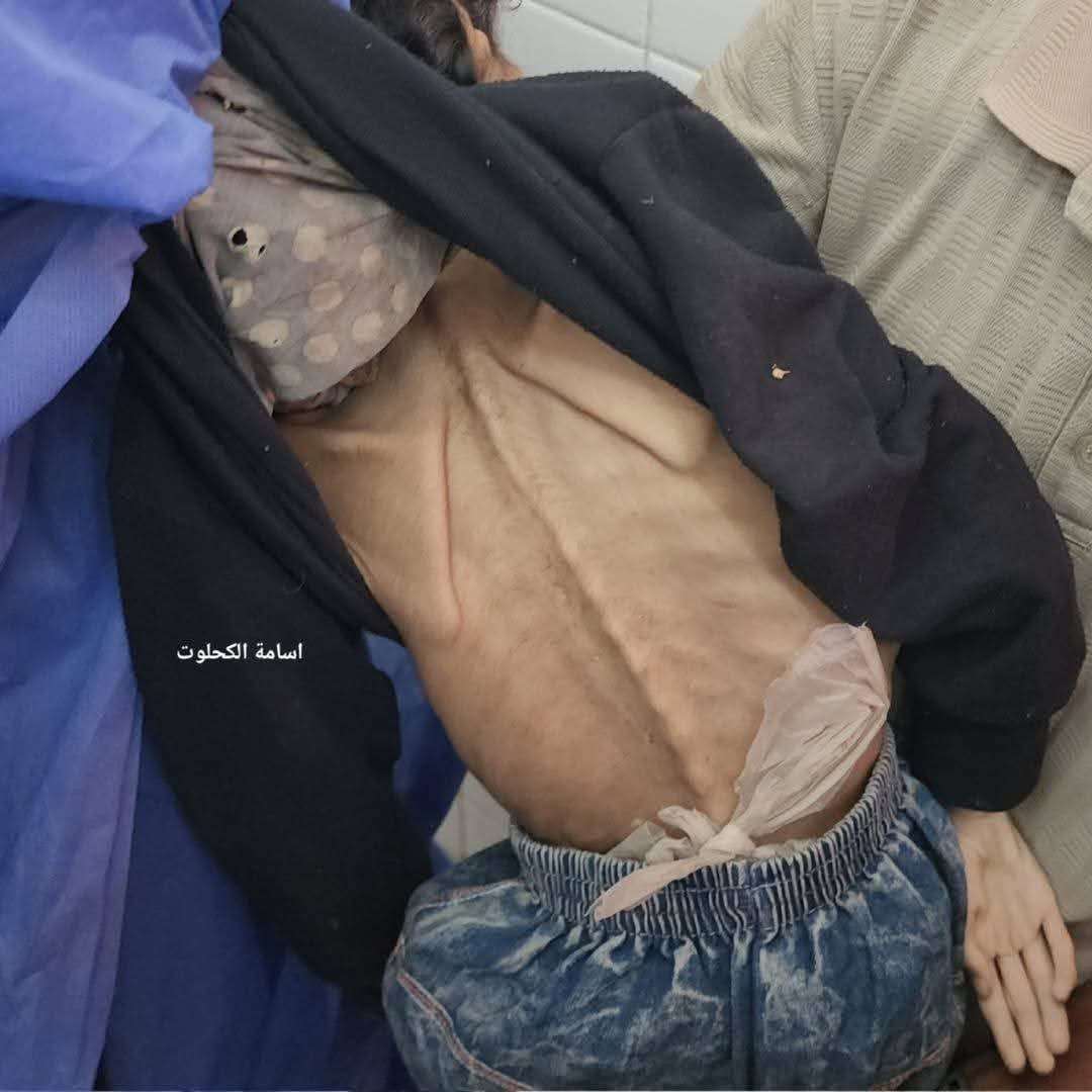 jaffery_anam's tweet image. "💔 10-year-old Nour Abu Selah died today from hunger. 🇮🇱 Israel’s blockade has starved 133 Palestinians to death, including 87 children 🕊️👶."
#Palestine
#WeAllHaveKids
#GazaGenocide