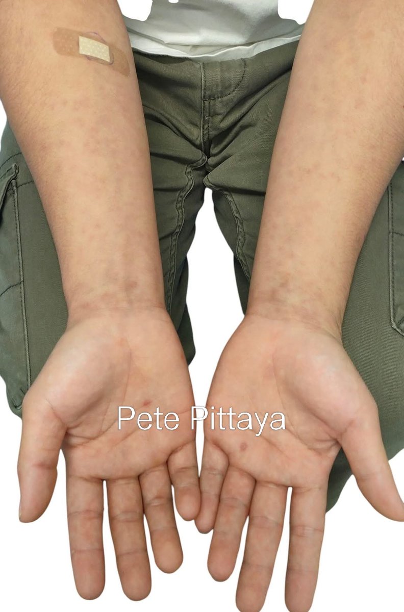 ซิฟิลิส
หลังฉีดยาไป อาจจะมีผื่นแดงจ้ำเข้มขึ้น แล้วจะหายไปเอง และบางรายอาจจะมีไข้หนาวสั่นตอนกลางคืน 

ก่อนฉีดอาจจะต้องทำการเทสดูก่อนว่าแพ้ยาหรือไม่
บางคนอาจจะแพ้ยาจนถึงขั้นเสียชีวิตได้