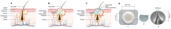 🧴💉 New in Biologics:

Efficacy of Dissolvable Microneedle Patches with Skincare Actives in Acne Management: A Monocentric Clinical Trial
📊by Muhammet Avcil et al.
🔗 mdpi.com/2673-8449/5/2/…
#Microneedles #AcneTreatment #Dermatology #TransdermalDelivery