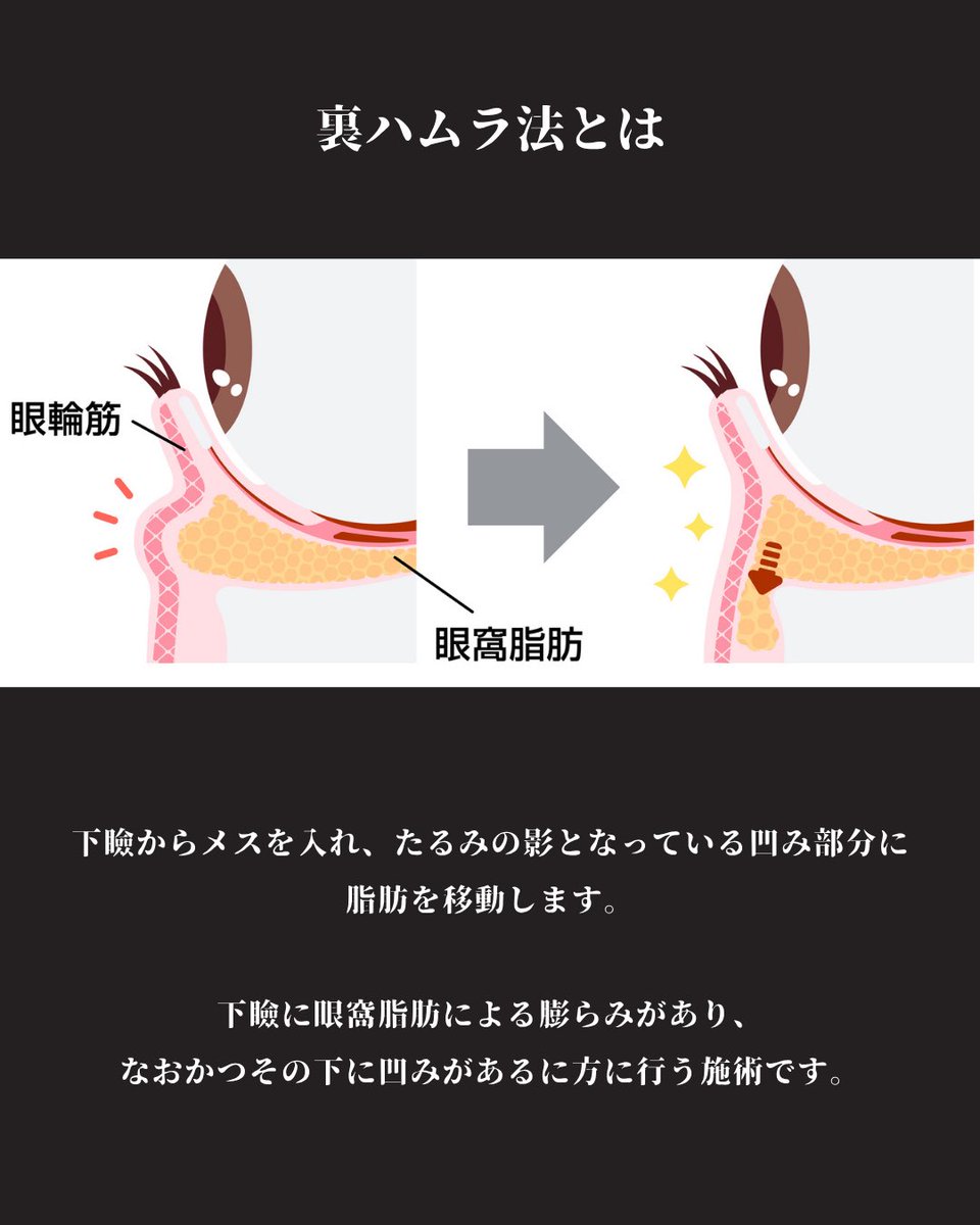 sakai_isea's tweet image. 裏ハムラ法の症例です。

目の下のクマ・たるみ取り（脂肪）

▪️料金
両目　445,000円(税込)

(麻酔費・痛み止め費・再施術費込み)

#裏ハムラ
#酒井新介
#イセア
#イセアクリニック 
#目の下のクマ
#目の下のたるみ
#クマ取り
#脱脂
#表ハムラ
#形成外科専門医
#美容整形
#美容外科専門医