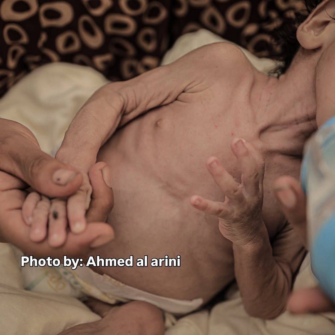 QudsNen's tweet photo. Seven-month-old infant Salim Awad is suffering from severe malnutrition due to the ongoing Israeli blockade and starvation policies in Gaza. https://t.co/QmALb0GYAe