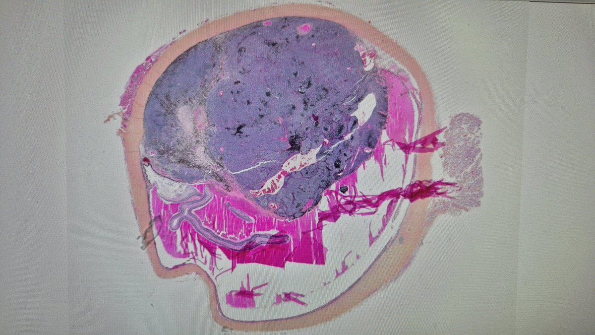 melanopath's tweet image. Portrait of an uveal melanoma. #pathart