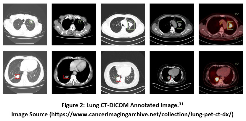 biotech_asia's tweet image. Quantum Enhanced Deep Learning Bio Inspired Model for Lung Tumors Detection and Severity Analysis in Clinical CT-DICOM Images
Read the Article here: biotech-asia.org/vol22no3/quant…
#Classification #DataProcessing #ImageSegmentation #LungNodulesDetection #MaskRCNN #biosciences