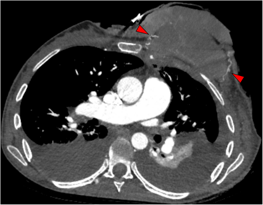 Our newest published article explores repeated emergency embolization for life-threatening bleeding from ulcerating breast carcinoma: a case report

link.springer.com/article/10.100…

#irad #oncology #interventionaloncology