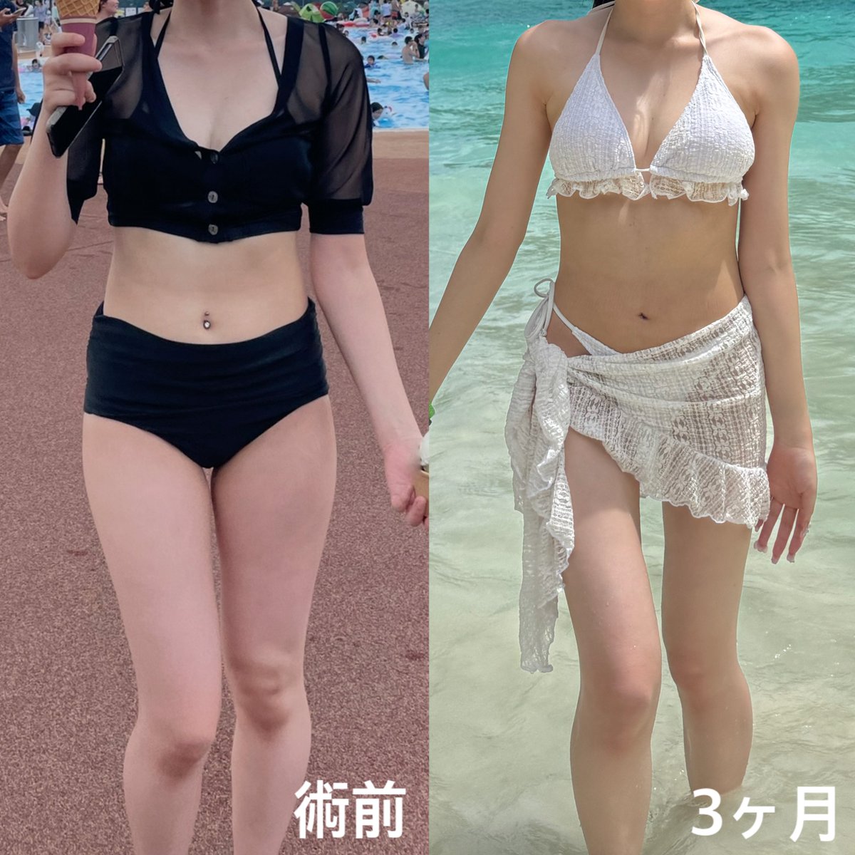 _kittychan22's tweet photo. レアートさんで太もも、ヒップラインの脂肪吸引・胸の脂肪移植をして3ヶ月経過しました✨

今までは体型が隠れる水着を着ていましたが今年の夏は念願のビキニが着られて嬉しいです😻👙

周りから痩せた？足細い！！と言われる機会が増えとても満足しています🫶🏻

#レアート #ソ院長 #脂肪吸引 #脂肪移植 https://t.co/GB23kCZ8NO