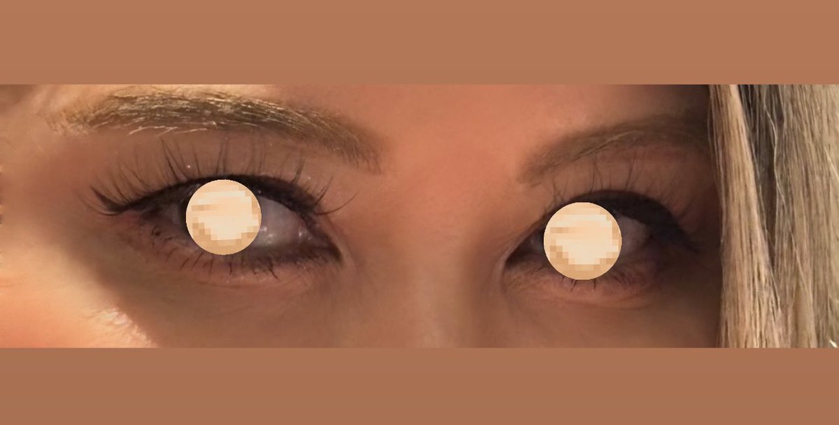 vikatu_1982's tweet photo. 眉下切開から3年半年たちました。また瞼のたるみが出てきました。目尻側の瞼が被ってきて二重がせばまってメイクした時アイラインが見えなくなる現象🥲
また眉下切開しなきゃいけないのか、こめかみリフトorフェイスリフトするまで我慢するか、、、。 https://t.co/535dHGcwpG