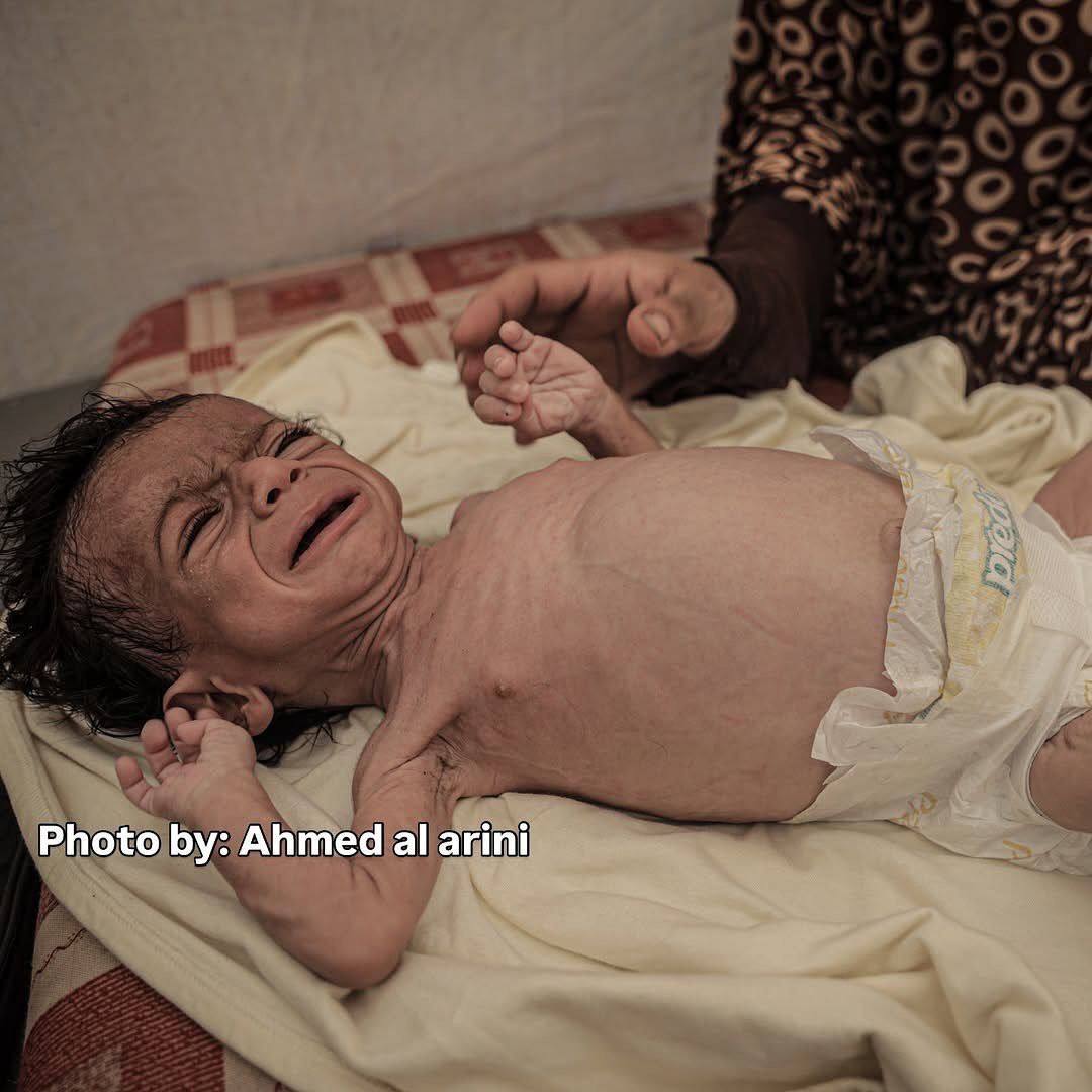 MilitantTracker's tweet image. 🚨🇵🇸 Gaza Media Office
▪️ Thousands of infants at risk of death due to Israeli ban on baby formula
▪️ Starvation now a documented weapon of war