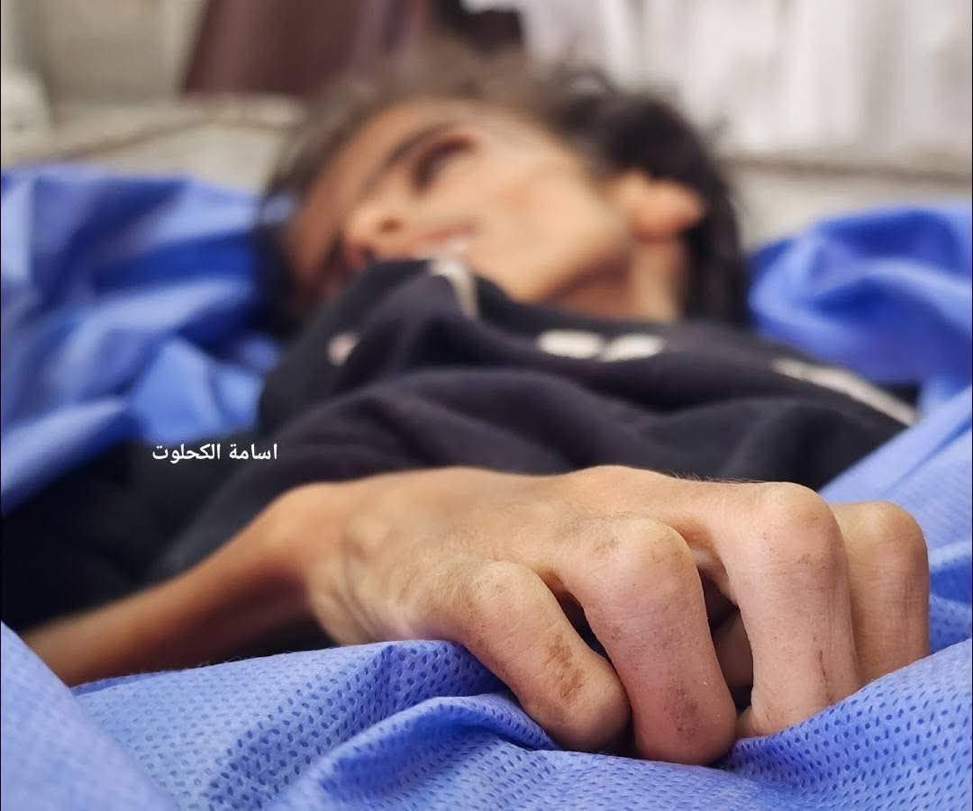 Ameer_wael07's tweet image. #Photos | Today, 10-year-old Nour Abu Sala'a died from complications of severe malnutrition resulting from the siege and starvation imposed by the occupation on Gaza... She was starved to death, in a systematic crime of genocide that is destroying the bodies of children and isโฆ