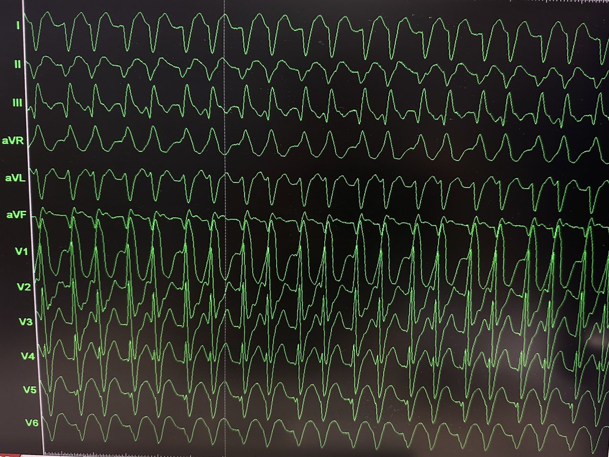 VT storm in a 78 yrs old male with hx. of CAD and CABG ; with LVEF: 35%! 
Amio/ Mexil combo didn’t effect! at the Lab; aggressive VT stim. couldn’t induce VT! In one ecg’s it’s irregular btw.! Mechanism? how to control it? ( non ablative modalities)! #Epeeps