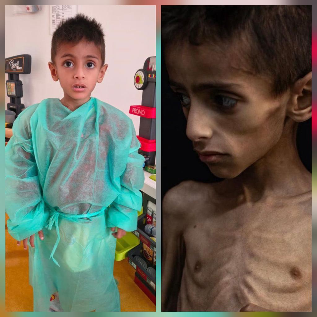 A photo of 5-year-old Osama al-Rakab has gone viral, used to falsely depict Israel as responsible for his condition, claiming Israel is starving children.

#TheFacts: Osama suffers from a serious genetic illness unrelated to the war. On June 12, we actively coordinated Osama's