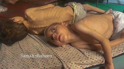 PalestineDays's tweet image. #Photos: Emaciated figures reduced to skin and bone, laying bare the severity of the relentless famine ravaging the Gaza Strip.