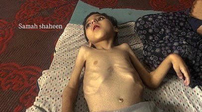 PalestineDays's tweet image. #Photos: Emaciated figures reduced to skin and bone, laying bare the severity of the relentless famine ravaging the Gaza Strip.