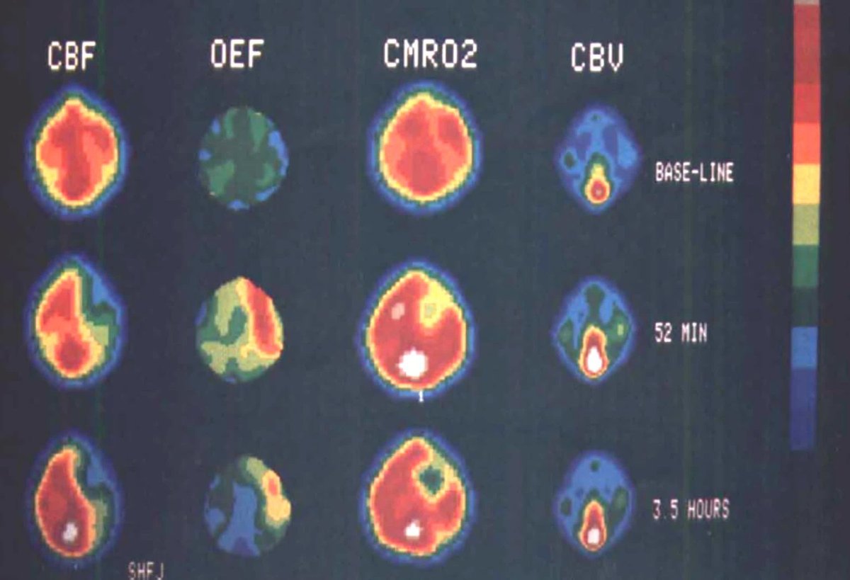 #STROKE Special Report by Baron from 2025 David G. Sherman Lecture: how PET revealed hemodynamic TIAs, validated the penumbra, showed penumbra persistence, proved patient selection matters, and uncovered selective neuronal loss. #AHAJournals ahajrnls.org/4lPYMFt