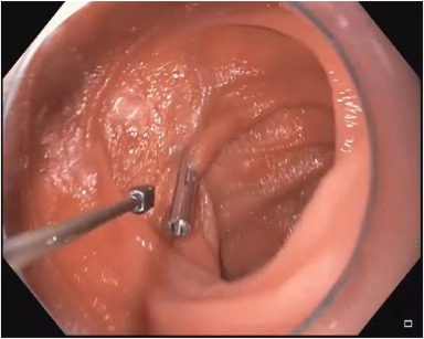 videogie's tweet image. Davekaran Buttar et al tackle &quot;Endoscopic management of candy cane syndrome with a lumen-apposing metal stent.&quot; videogie.org/article/S2468-…

#GITwitter 

@babudayyeh