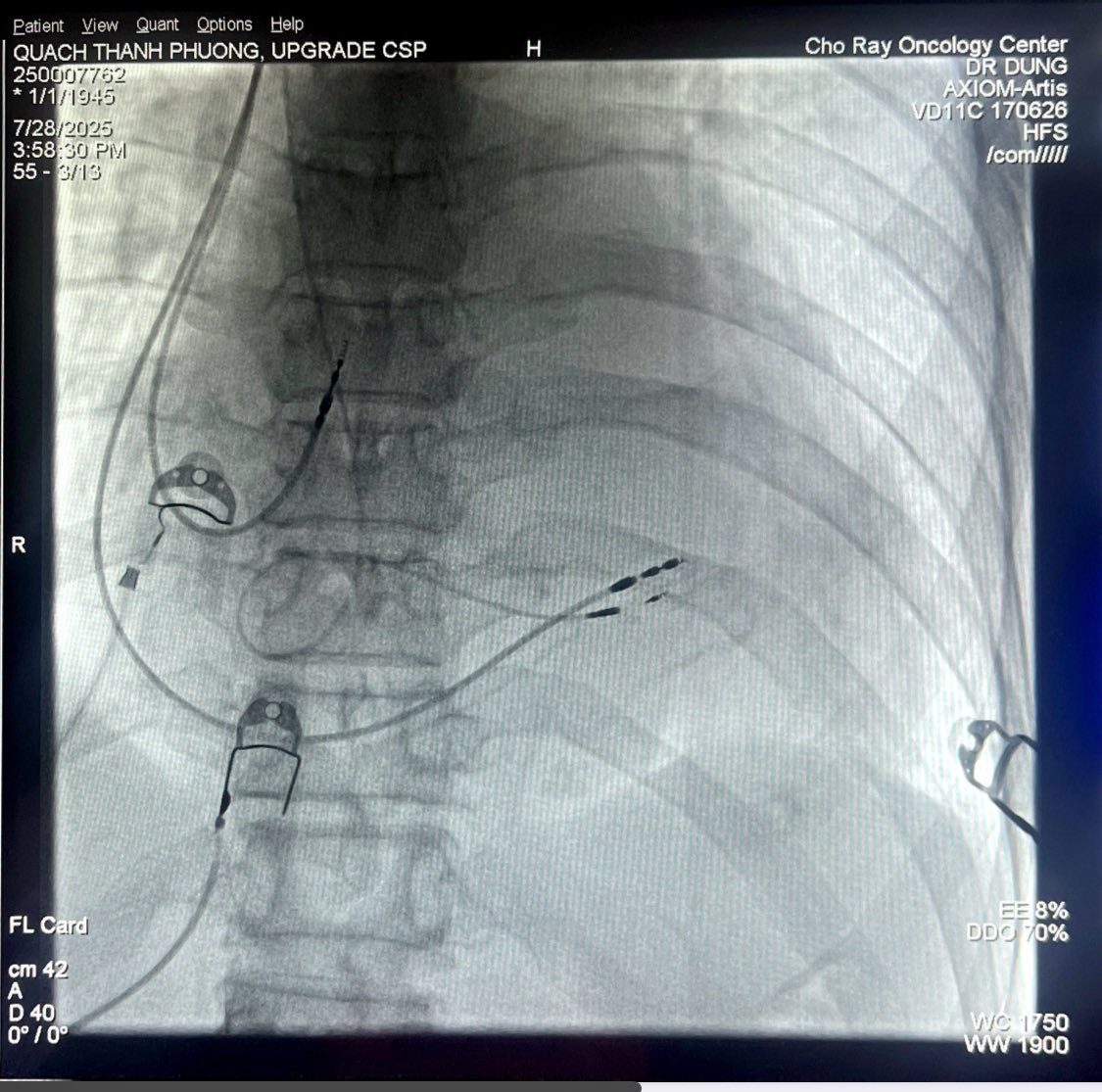 Very long LVAT in an upgrading CSP case who had a narrow QRS intrinsic rhythm. Simultaneously, loss of capturing both local myocardium and LPF caused concomitant prolongation of LVAT, V6-V1 interpeak, and pacing QRS duration.
#Epeeps #LBBAP