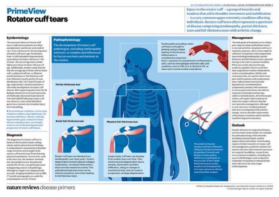MoAImam's tweet image. Rotator Cuff Tears”
(Nature PrimeView 2024)👇🏼
▶️epidemiology
▶️pathophysiology
▶️diagnosis
▶️management
▶️outlook
#shoulder #rotatorcuff
nature.com/articles/s4157…