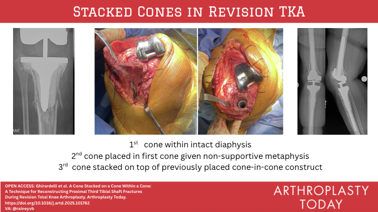 Arthroplasty Today (@arthrotoday) on Twitter photo Bypass the break:
Cone-on-cone and cone-in-cone constructs can help you tackle tibial fractures in revision TKA.
Technique: <a href="/GhirardelliMD/">stefano ghirardelli</a> <a href="/bethgausdenmd/">Elizabeth Gausden</a> <a href="/DrPeterSculco/">Dr. Peter Sculco</a> <a href="/BrianChalmersMD/">Brian Chalmers</a>
VA: <a href="/raineyvb/">Joshua Rainey, MD</a>
arthroplastytoday.org/article/S2352-… Bypass the break:
Cone-on-cone and cone-in-cone constructs can help you tackle tibial fractures in revision TKA.
Technique: <a href="/GhirardelliMD/">stefano ghirardelli</a> <a href="/bethgausdenmd/">Elizabeth Gausden</a> <a href="/DrPeterSculco/">Dr. Peter Sculco</a> <a href="/BrianChalmersMD/">Brian Chalmers</a>
VA: <a href="/raineyvb/">Joshua Rainey, MD</a>
arthroplastytoday.org/article/S2352-…