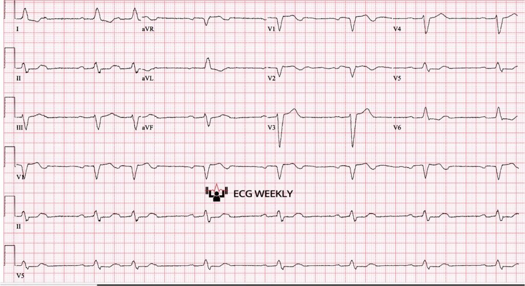 A 79-year-old man is sent to a community hospital for evaluation of bradycardia discovered at his nursing facility. He is ultimately transferred to a tertiary care facility for consideration of pacemaker placement after the following ECG is obtained:ecgweekly.com/weekly-workout…