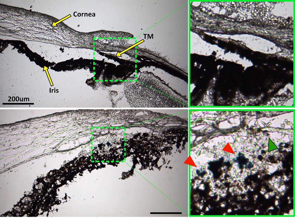 Michael F. Chiang, MD (@neidirector) on Twitter photo Trabecular meshwork cell therapy has been proposed as next-generation treatment for #glaucoma. Therapy gets magnetically steered into place
@EthierOcularlab <a href="/GeorgiaTech/">Georgia Tech</a> <a href="/MEGeorgiaTech/">Georgia Tech ME</a> <a href="/CoulterBME/">Coulter BME | Emory & Georgia Tech</a> <a href="/uiowaeye/">UIowa Eye</a> <a href="/EmoryEyeCenter/">Emory Eye Center</a> #NIHfunded
<a href="/eLife/">eLife - the journal</a>: brnw.ch/21wUtCj Trabecular meshwork cell therapy has been proposed as next-generation treatment for #glaucoma. Therapy gets magnetically steered into place
@EthierOcularlab <a href="/GeorgiaTech/">Georgia Tech</a> <a href="/MEGeorgiaTech/">Georgia Tech ME</a> <a href="/CoulterBME/">Coulter BME | Emory & Georgia Tech</a> <a href="/uiowaeye/">UIowa Eye</a> <a href="/EmoryEyeCenter/">Emory Eye Center</a> #NIHfunded
<a href="/eLife/">eLife - the journal</a>: brnw.ch/21wUtCj