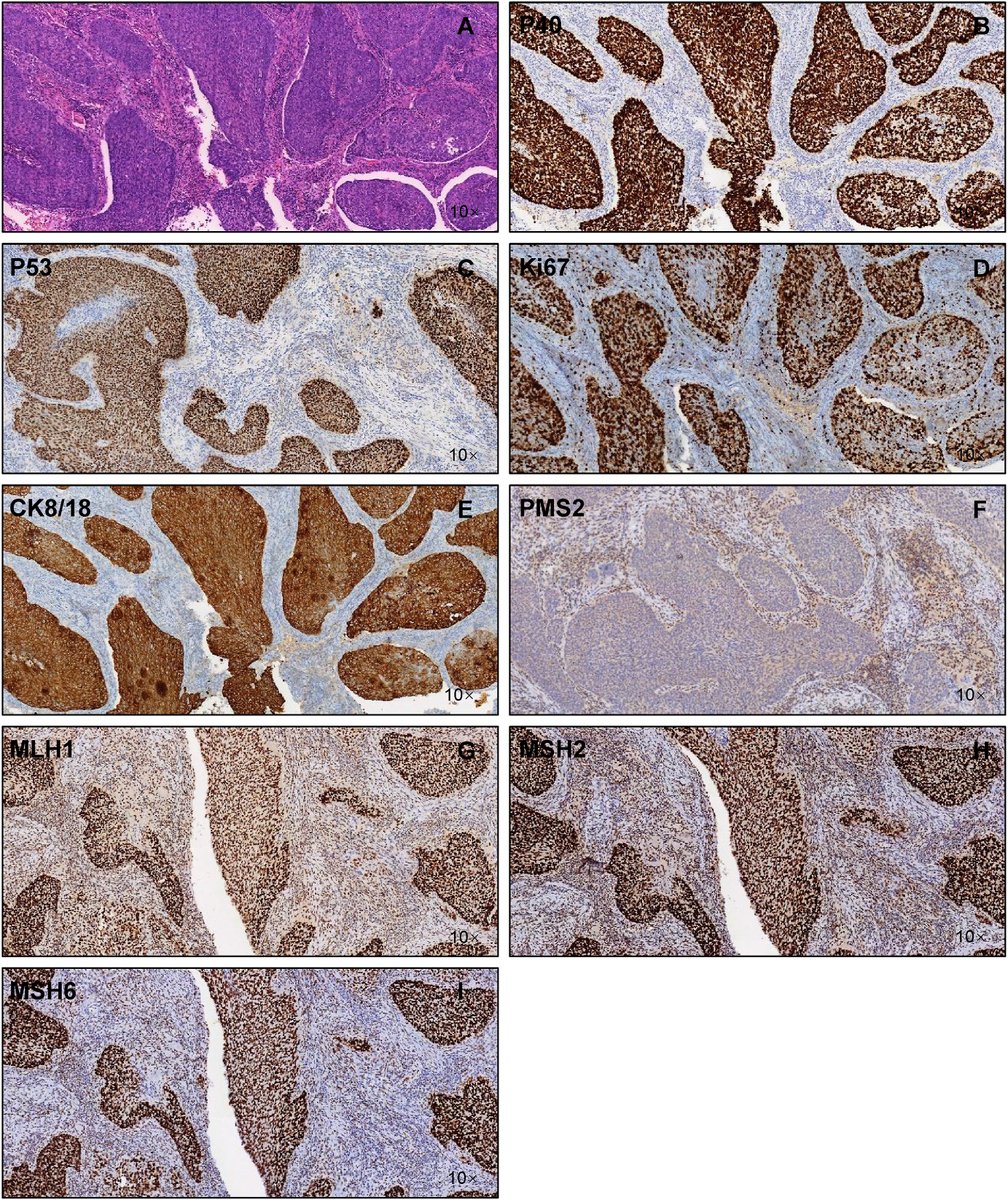 Human_Pathology's tweet image. New in #HumPathol: Incidence of MSI-H esophageal carcinoma and related identification of genomic alterations: A multi-center real-world study. sciencedirect.com/science/articl… #pathology #PathTwitter #PathX #GIpath