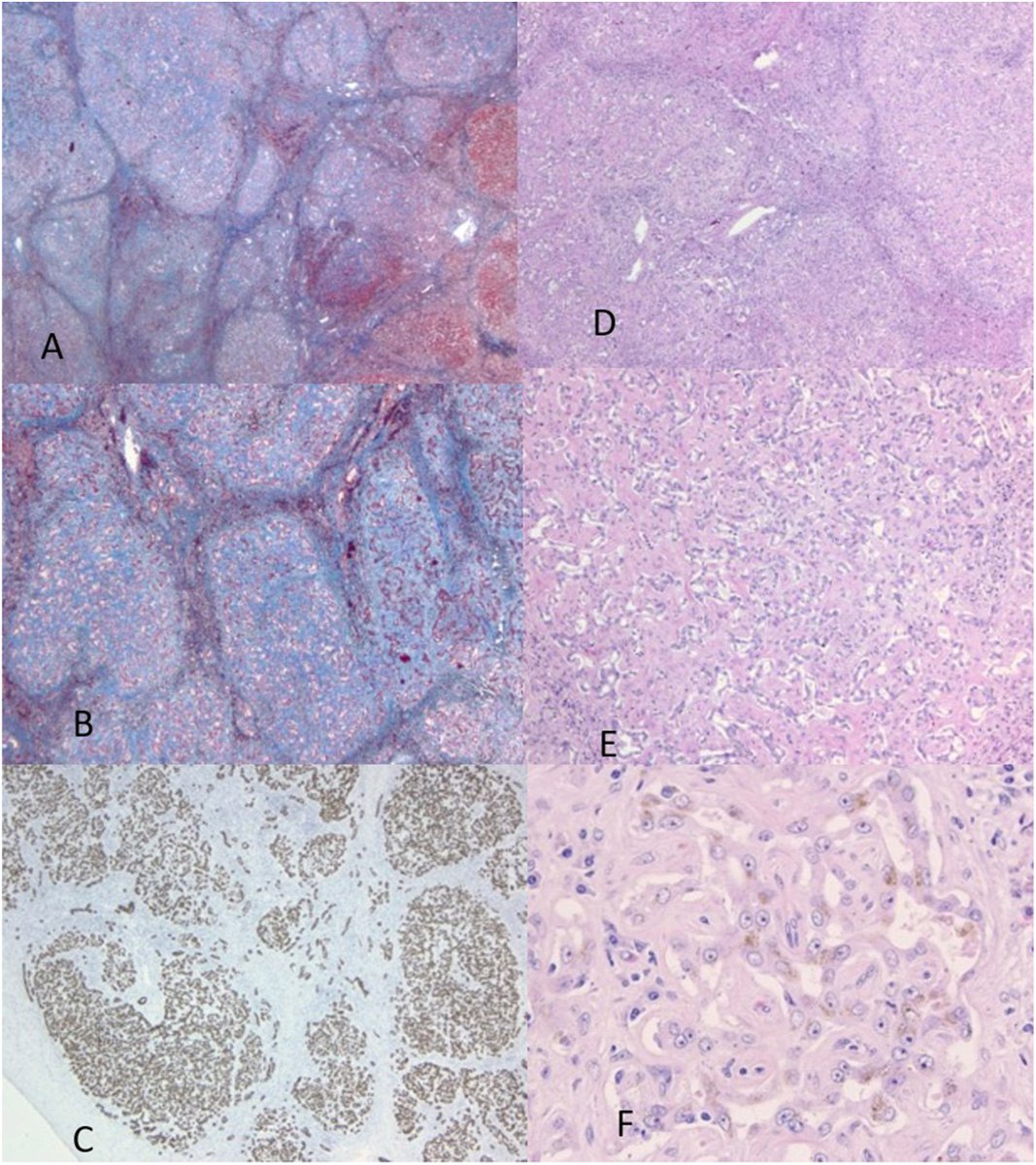 Human_Pathology's tweet image. New in #HumPathol: Biliary pseudo tumor associated with hepatic atrophy. sciencedirect.com/science/articl… #pathology #PathTwitter #PathX #liverpath