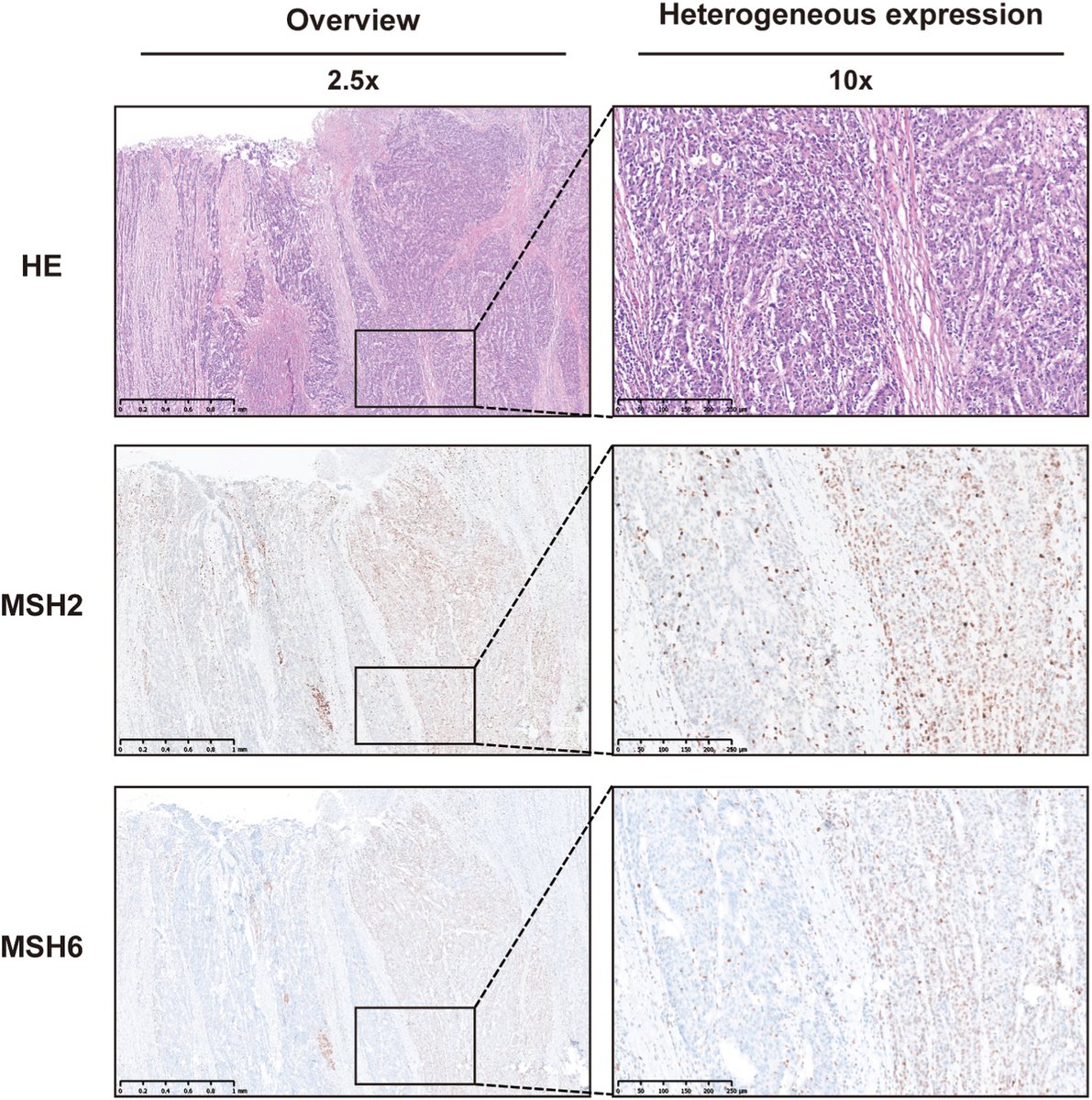 Human_Pathology's tweet image. New in #HumPathol: Identification of Constitutional MLH1 Methylation in MLH1-Deficient Colorectal Cancer. sciencedirect.com/science/articl… #pathology #PathTwitter #PathX #GIpath
