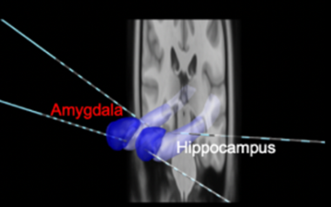 The_Strange_Lab's tweet photo. New paper out in @NatureComms with 1st author
@mcosta_17. Activity patterns within gamma bursts during emotional memory encoding reappear at retrieval. Burst activity is key as overall pattern of encoding-retrieval similarity in gamma is anti-correlation in amygdala &amp; hippocampus https://t.co/0VMftAvUCi