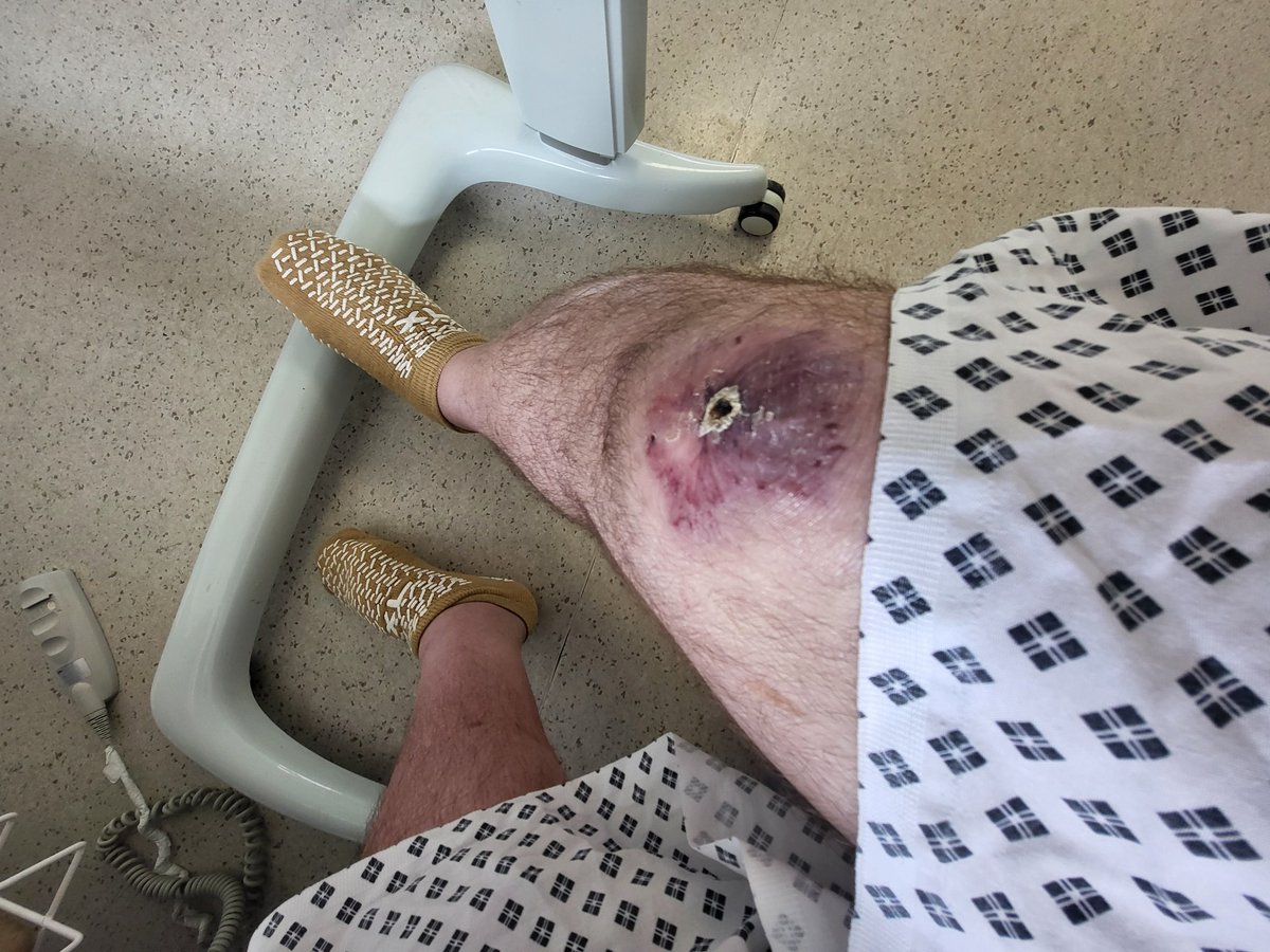 TimmyUk's tweet image. ... my knee wound today wearing my excellent glasses watching sloth movie on SkyGo in sideroom in hospital ... ๐ฅ ๐ ๐ง ๐ฑ ๐ผ ๐คณ ๐ฐ ๐ก ๐ฆฅ ๐ฌ ๐ ๐ฅ ๐ซ